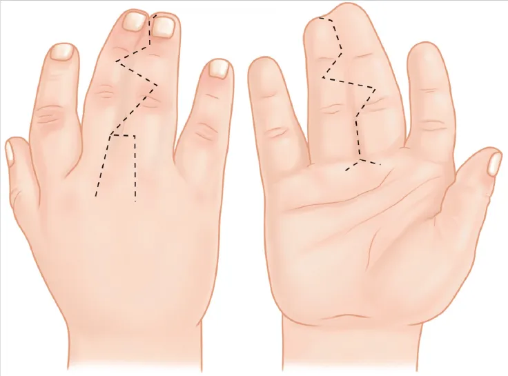 Syndactyly A Comprehensive Guide To Treatment Options Dr Faisal Ameer