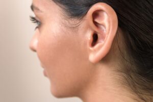 Otoplasty in Dubai