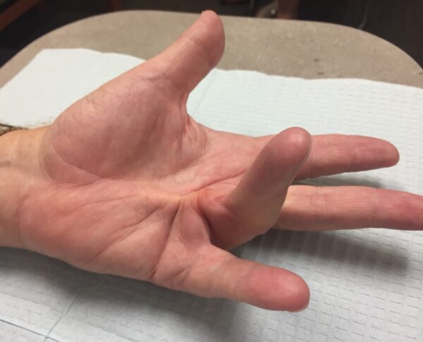 dupuytrens Dupuytren's contracture